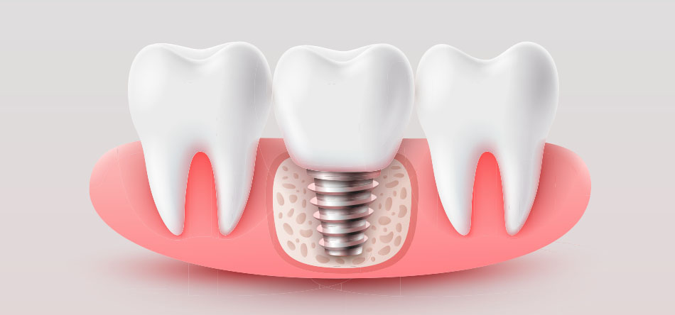 aesthetics title Dental implants