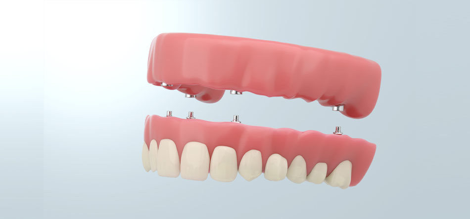 aesthetics title Dentures on implants
