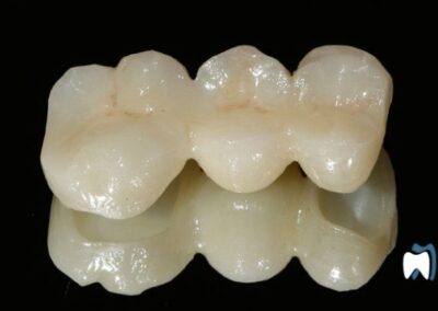 Dental bridge fitted at the practice