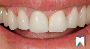 Cosmetic dentistry case study 1 — after treatment