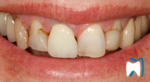Cosmetic dentistry case study 1 — before treatment