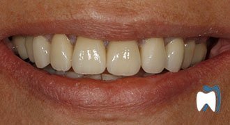 Cosmetic dentistry case study 10 — after treatment