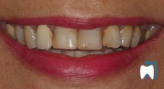 Cosmetic dentistry case study 10 — before treatment