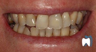 Cosmetic dentistry case study 11 — after treatment
