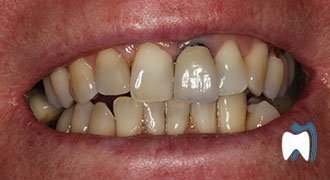Cosmetic dentistry case study 11 — before treatment