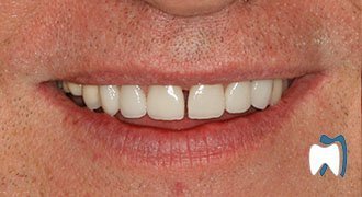 Cosmetic dentistry case study 12 — after treatment