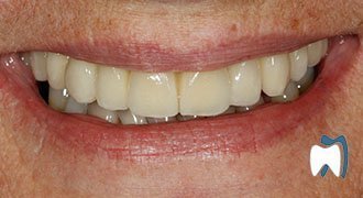 Cosmetic dentistry case study 13 — after treatment