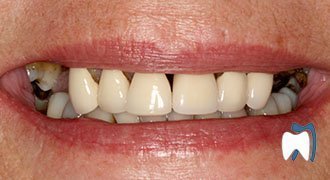 Cosmetic dentistry case study 13 — before treatment