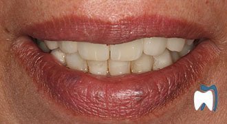 Cosmetic dentistry case study 14 — after treatment