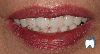 Cosmetic dentistry case study 14 — before treatment