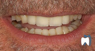 Cosmetic dentistry case study 15 — after treatment