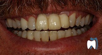 Cosmetic dentistry case study 16 — before treatment