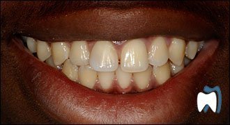 Cosmetic dentistry case study 17 — before treatment