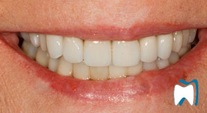 Cosmetic dentistry case study 2 — after treatment