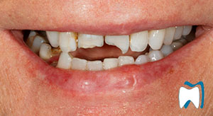 Cosmetic dentistry case study 2 — before treatment