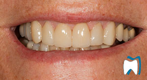 Cosmetic dentistry case study 3 — after treatment
