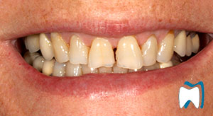 Cosmetic dentistry case study 3 — before treatment