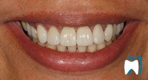 Cosmetic dentistry case study 4 — after treatment