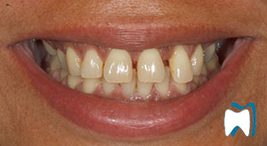 Cosmetic dentistry case study 4 — before treatment