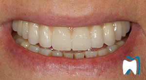 Cosmetic dentistry case study 5 — after treatment