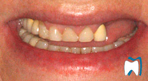 Cosmetic dentistry case study 5 — before treatment