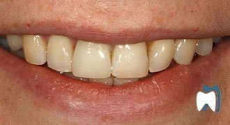 Cosmetic dentistry case study 6 — after treatment