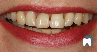 Cosmetic dentistry case study 6 — before treatment