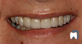 Cosmetic dentistry case study 7 — after treatment