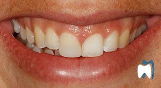 Cosmetic dentistry case study 8 — after treatment