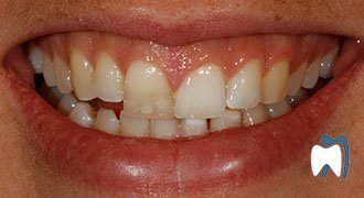 Cosmetic dentistry case study 8 — before treatment