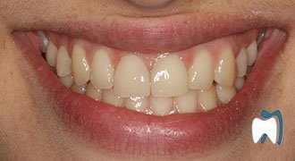 Cosmetic dentistry case study 9 — after treatment