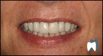 Implant complication case study 1 — after treatment