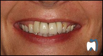 Implant complication case study 1 — before treatment