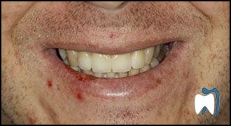Implant complication case study 2 — after treatment