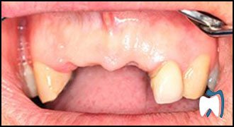 Implant complication case study 2 — before treatment