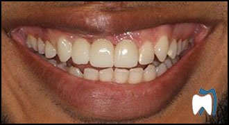 Implant complication case study 3 — after treatment