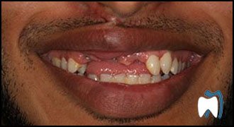 Implant complication case study 3 — before treatment