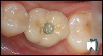 Implant complication case study 4 — after treatment