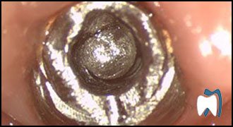 Implant complication case study 4 — before treatment