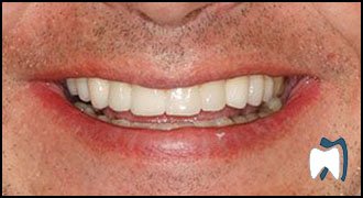 Implant complication case study 5 — after treatment