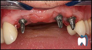 Implant complication case study 5 — before treatment