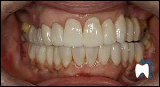 Implant complication case study 6 — after treatment
