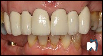 Implant complication case study 6 — before treatment