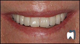 Implant complication case study 7 — after treatment
