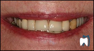 Implant complication case study 7 — before treatment