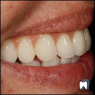 Smile result from the practice