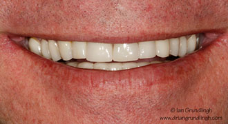 Smile makeover case study 1 — after treatment
