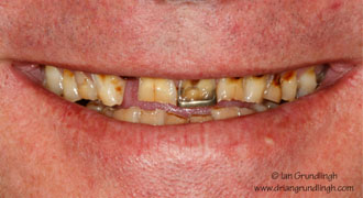Smile makeover case study 1 — before treatment