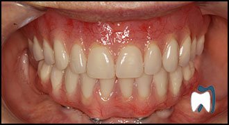 Smile makeover case study 10 — after treatment