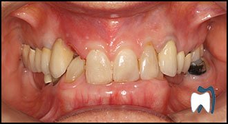 Smile makeover case study 10 — before treatment